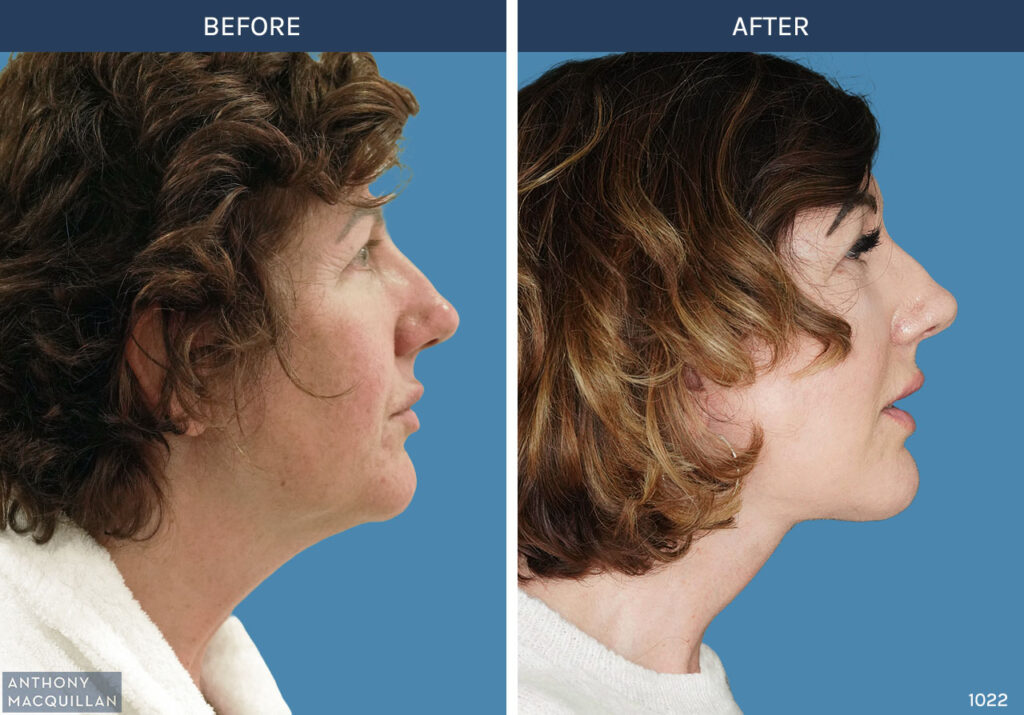 1022 - Deep Plane Face Lift with Deep Neck Lift by Anthony MacQuillan Side Right