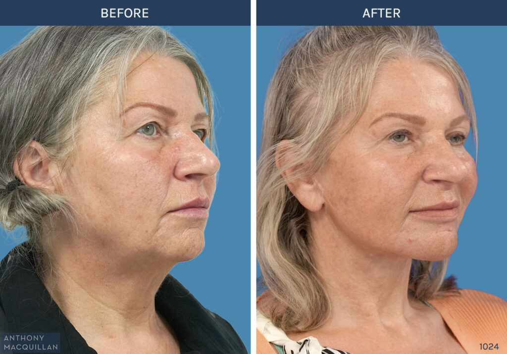 1024 - Deep Plane Face Lift with Deep Neck Lift by Anthony MacQuillan 45 Right