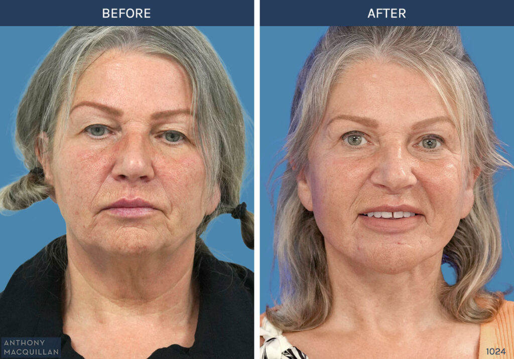 1024 - Deep Plane Face Lift with Deep Neck Lift by Anthony MacQuillan Front