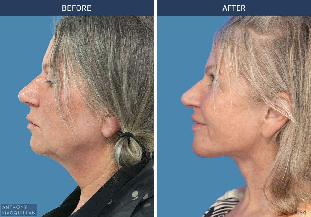 1024 - Deep Plane Face Lift with Deep Neck Lift by Anthony MacQuillan Side Left