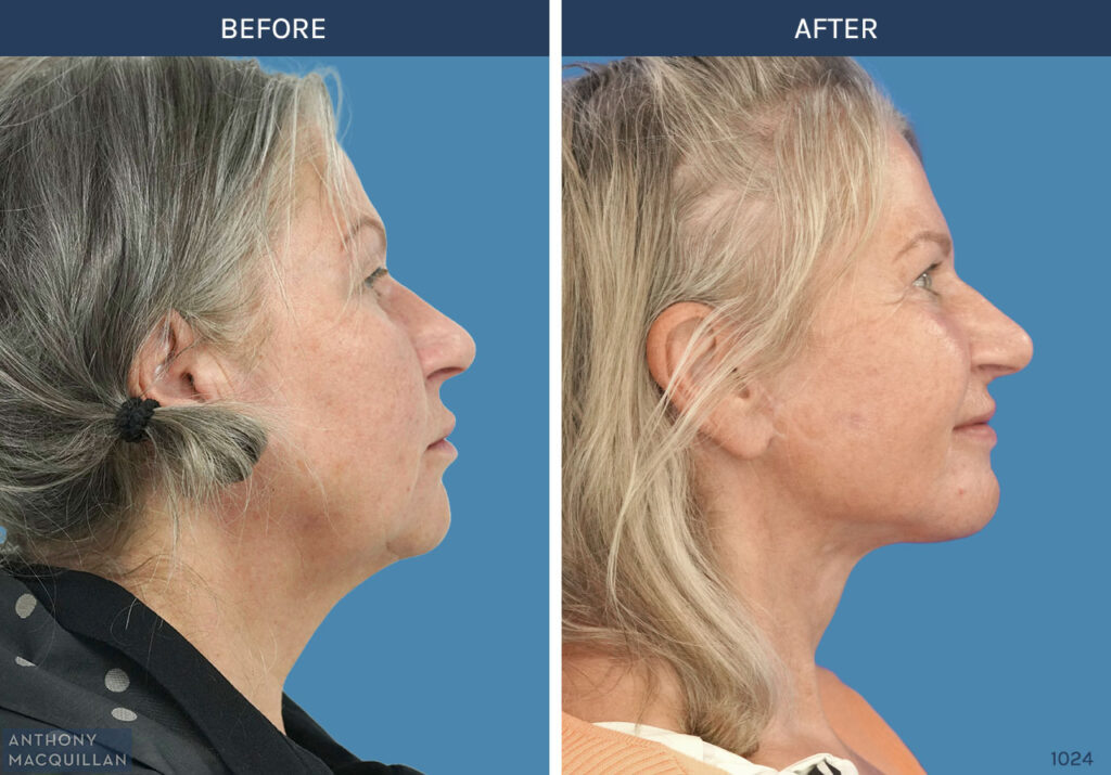 1024 - Deep Plane Face Lift with Deep Neck Lift by Anthony MacQuillan Side Right