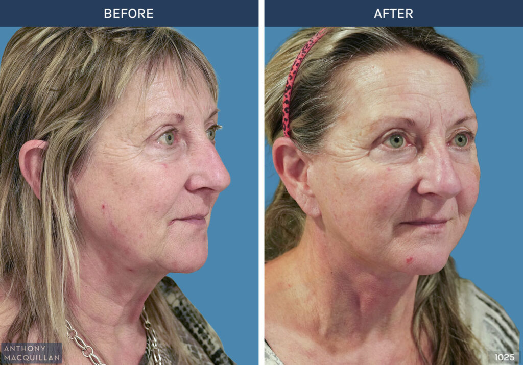 1025 - Deep Plane Face Lift with Deep Neck Lift by Anthony MacQuillan 45 Right