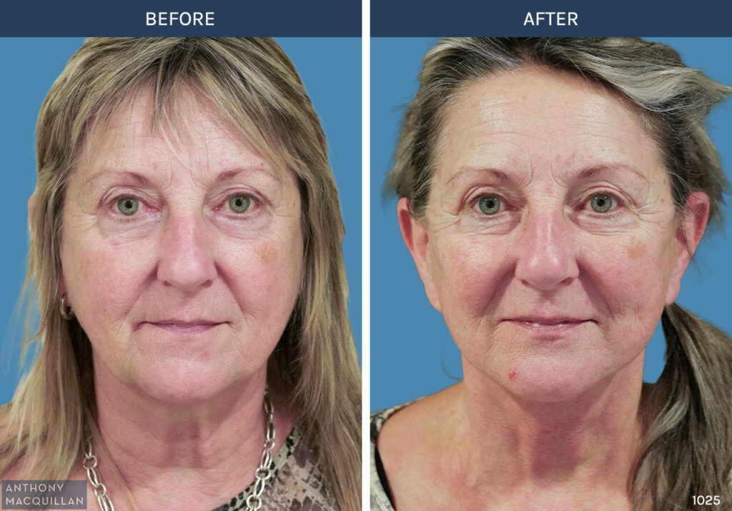 1025 - Deep Plane Face Lift with Deep Neck Lift by Anthony MacQuillan Front