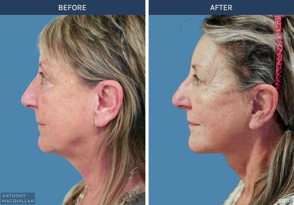 1025 - Deep Plane Face Lift with Deep Neck Lift by Anthony MacQuillan Side Left
