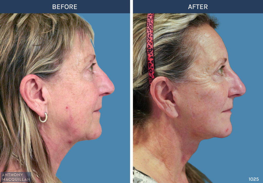 1025 - Deep Plane Face Lift with Deep Neck Lift by Anthony MacQuillan Side Right