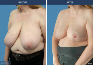 2000 - Breast Reduction by Anthony MacQuillan 45 L