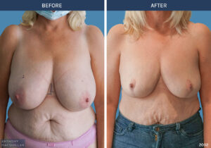 2002 - Breast Reduction by Anthony MacQuillan Front