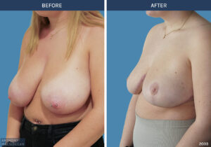 2003 - Breast Reduction by Anthony MacQuillan 45 L
