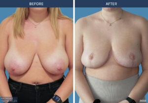 2003 - Breast Reduction by Anthony MacQuillan Front