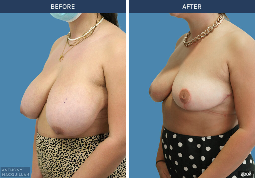 2004 - Breast Reduction by Anthony MacQuillan 45 L