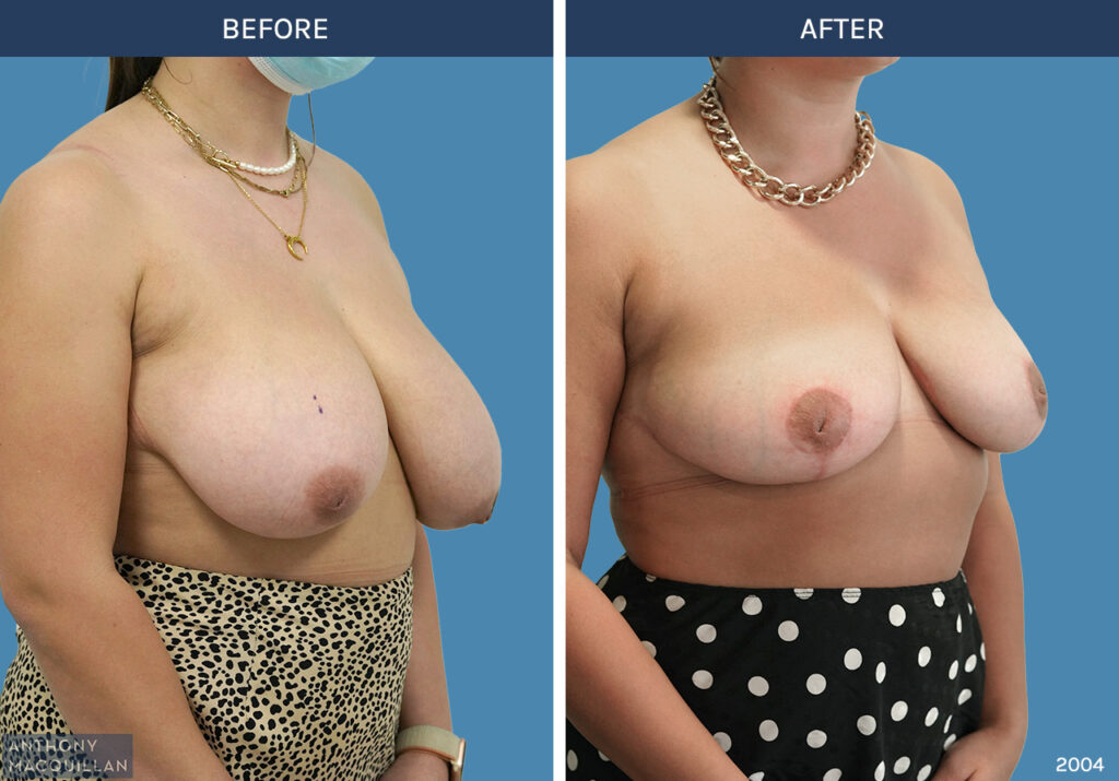 2004 - Breast Reduction by Anthony MacQuillan 45 R