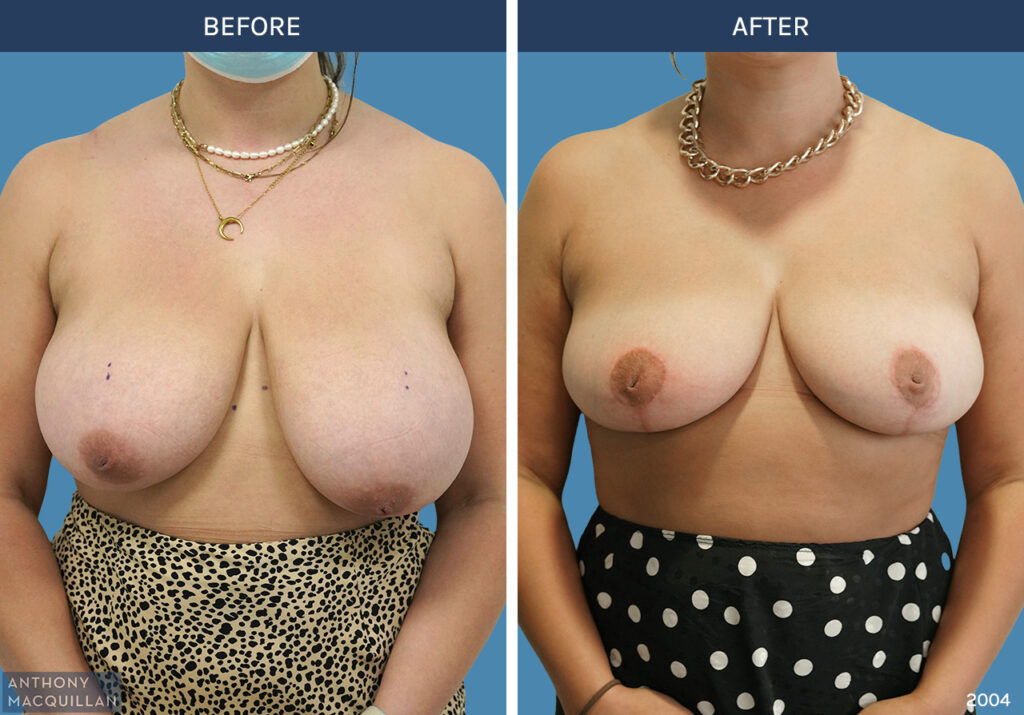 2004 - Breast Reduction by Anthony MacQuillan Front