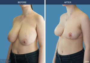2008 - Breast Reduction by Anthony MacQuillan 45 L