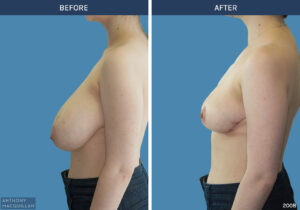 2008 - Breast Reduction by Anthony MacQuillan Side L