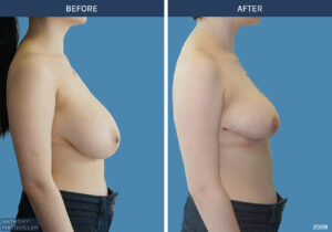 2008 - Breast Reduction by Anthony MacQuillan Side R