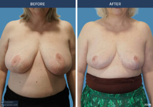 2009 - Breast Reduction by Anthony MacQuillan Front