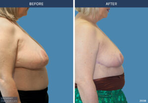 2009 - Breast Reduction by Anthony MacQuillan Side R