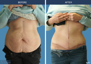 3000 - Abdominoplasty by Anthony MacQuillan Front