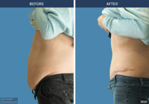 3000 - Abdominoplasty by Anthony MacQuillan Side L