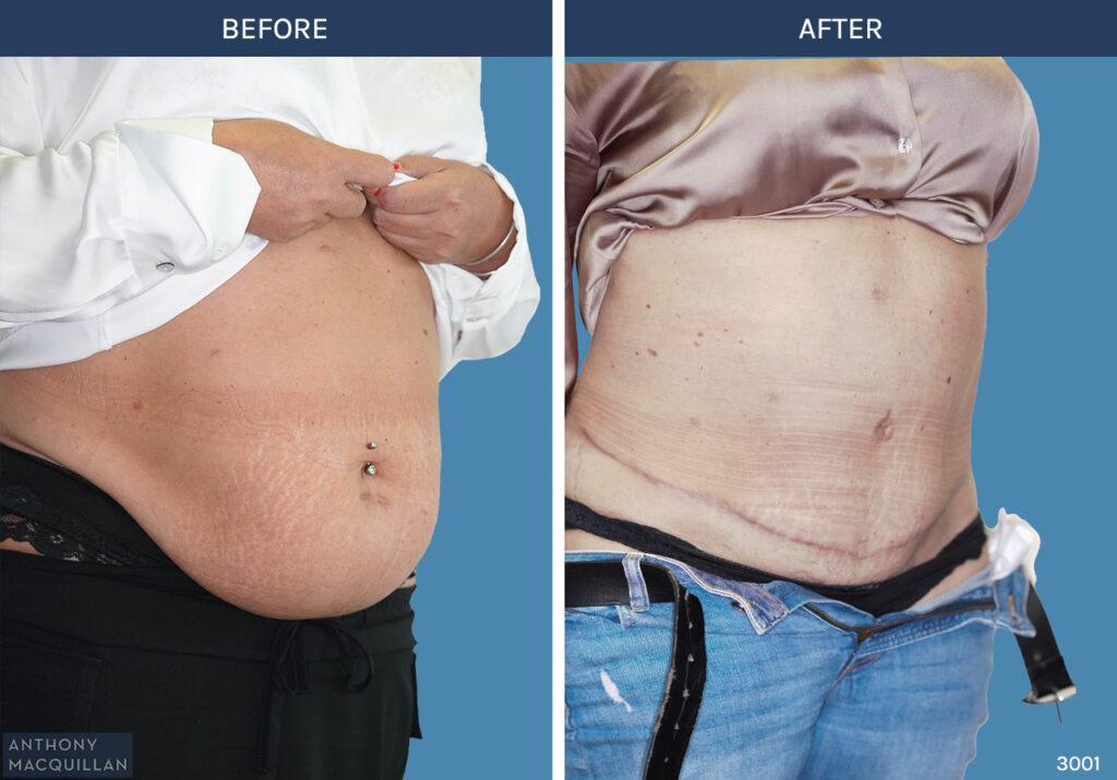 3000 - Abdominoplasty by Anthony MacQuillan Side R