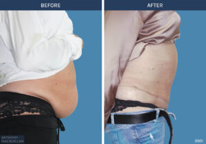 3001 - Abdominoplasty by Anthony MacQuillan Side R