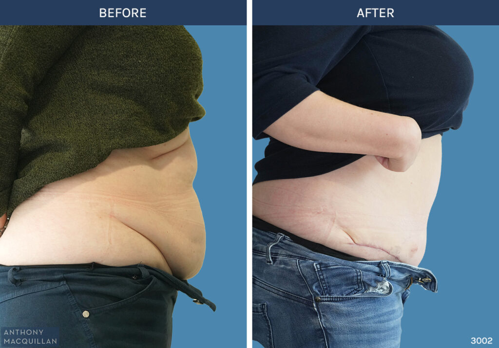 3002 - Abdominoplasty by Anthony MacQuillan Side R