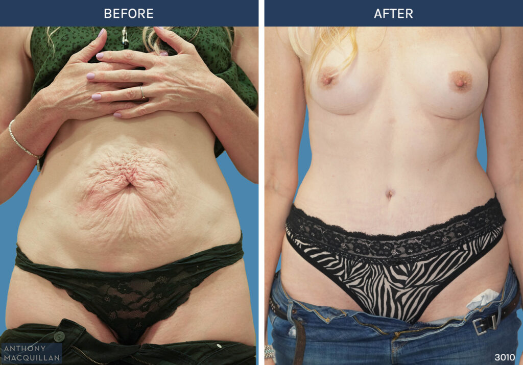3010 - Abdominoplasty by Anthony MacQuillan Front