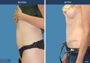 3010 - Abdominoplasty by Anthony MacQuillan Side L