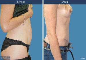 3010 - Abdominoplasty by Anthony MacQuillan Side R