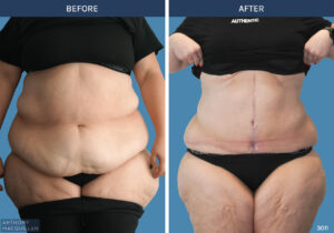 3011 - Abdominoplasty by Anthony MacQuillan Front