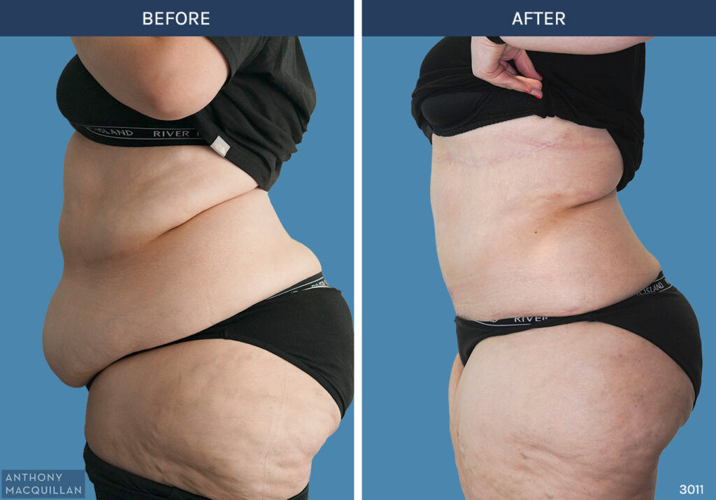 3011 - Abdominoplasty by Anthony MacQuillan Side L
