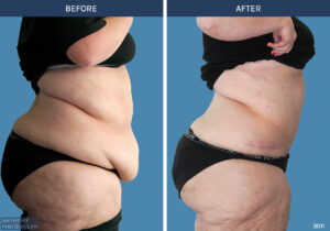 3011 - Abdominoplasty by Anthony MacQuillan Side R