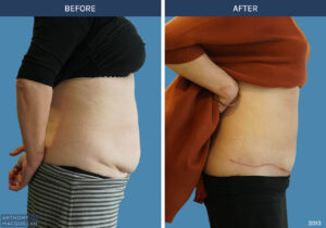 3013 - Abdominoplasty by Anthony MacQuillan Side R