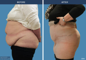 3014 - Abdominoplasty by Anthony MacQuillan Front