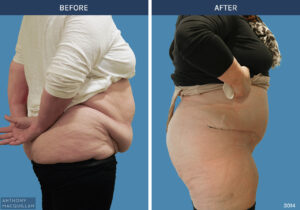 3014 - Abdominoplasty by Anthony MacQuillan Side R