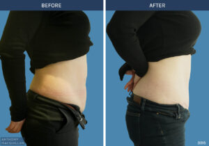 3015 - Abdominoplasty by Anthony MacQuillan Side R