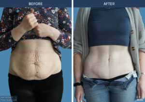 3020 - Abdominoplasty by Anthony MacQuillan Front