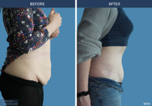 3020 - Abdominoplasty by Anthony MacQuillan Side R