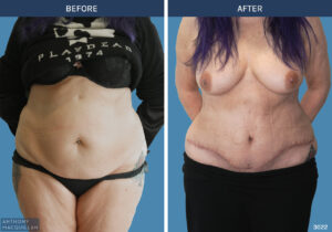 3022 - Abdominoplasty by Anthony MacQuillan Front