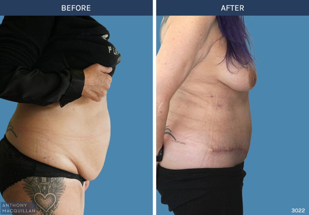 3022 - Abdominoplasty by Anthony MacQuillan Side R