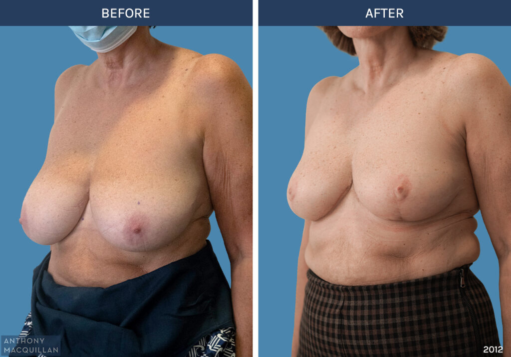 2012 - Bilateral Breast Reduction by Anthony MacQuillan 45 Left