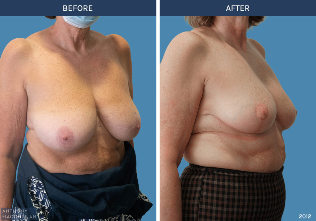 2012 - Bilateral Breast Reduction by Anthony MacQuillan 45 Right