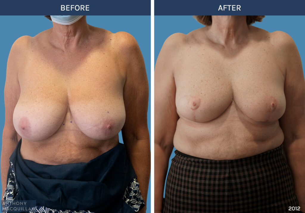 2012 - Bilateral Breast Reduction by Anthony MacQuillan Front