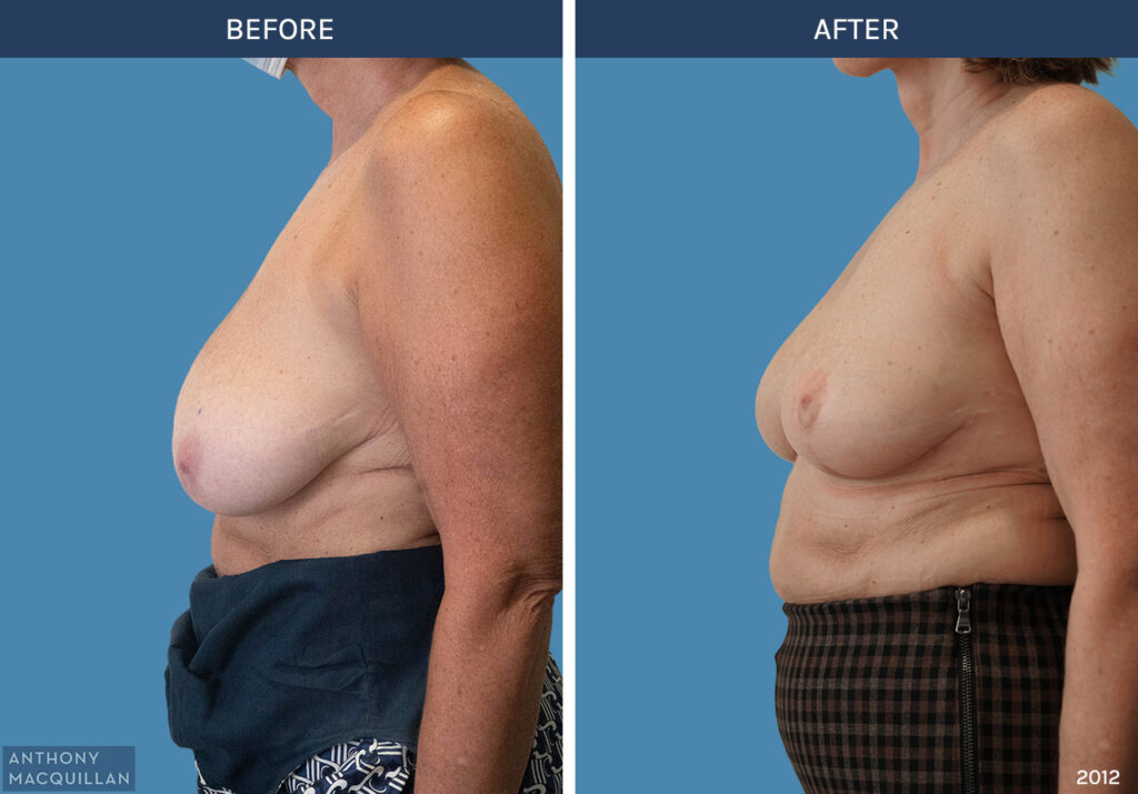 2012 - Bilateral Breast Reduction by Anthony MacQuillan Side Left