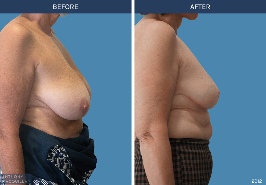 2012 - Bilateral Breast Reduction by Anthony MacQuillan Side Right