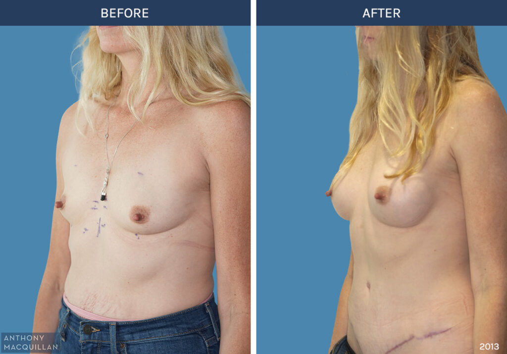 2013 - Breast Augmentation by Anthony MacQuillan 45 Left