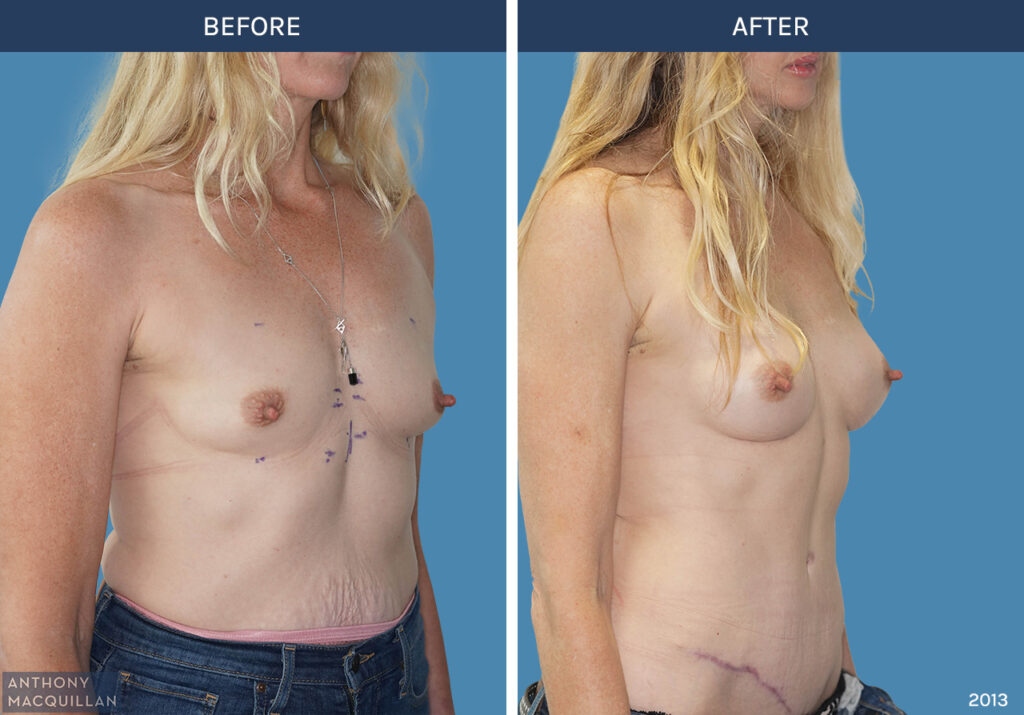 2013 - Breast Augmentation by Anthony MacQuillan 45 Right