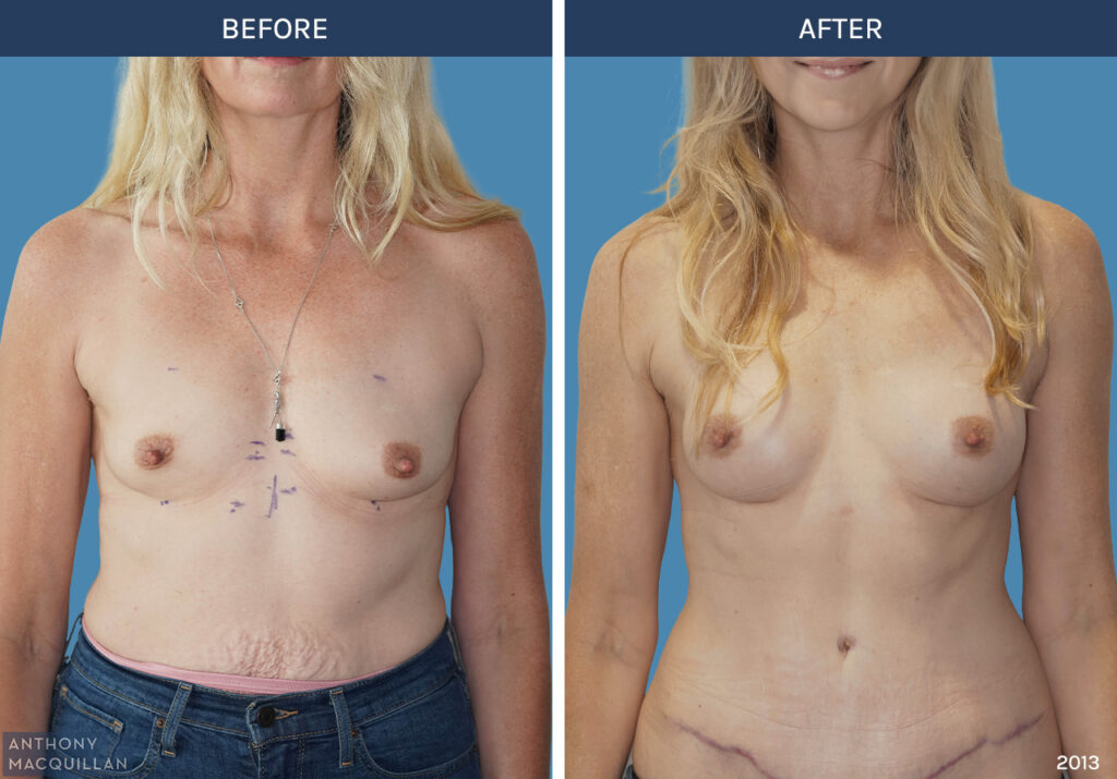 2013 - Breast Augmentation by Anthony MacQuillan Front