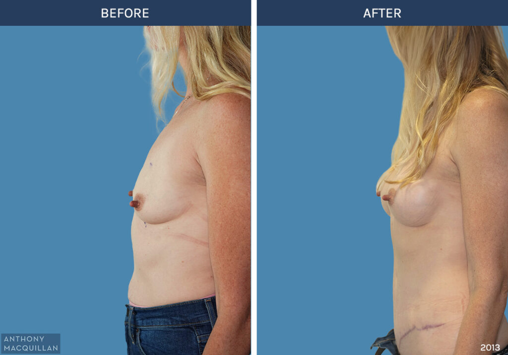2013 - Breast Augmentation by Anthony MacQuillan Side Left