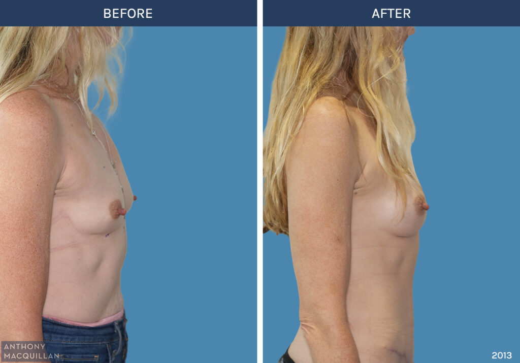 2013 - Breast Augmentation by Anthony MacQuillan Side Right